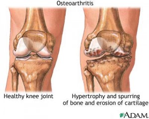 osteoarthritis image