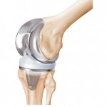 knee replacement image