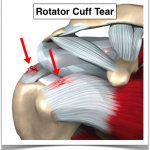 rotator-cuff-tear illustration