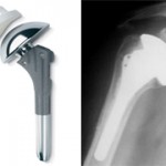 Reverse Shoulder Joint Prosthesis.   The “ball” is at the shoulder blade. The “socket” is at the head of the upper arm.