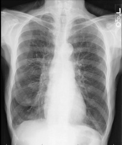 chest x-ray